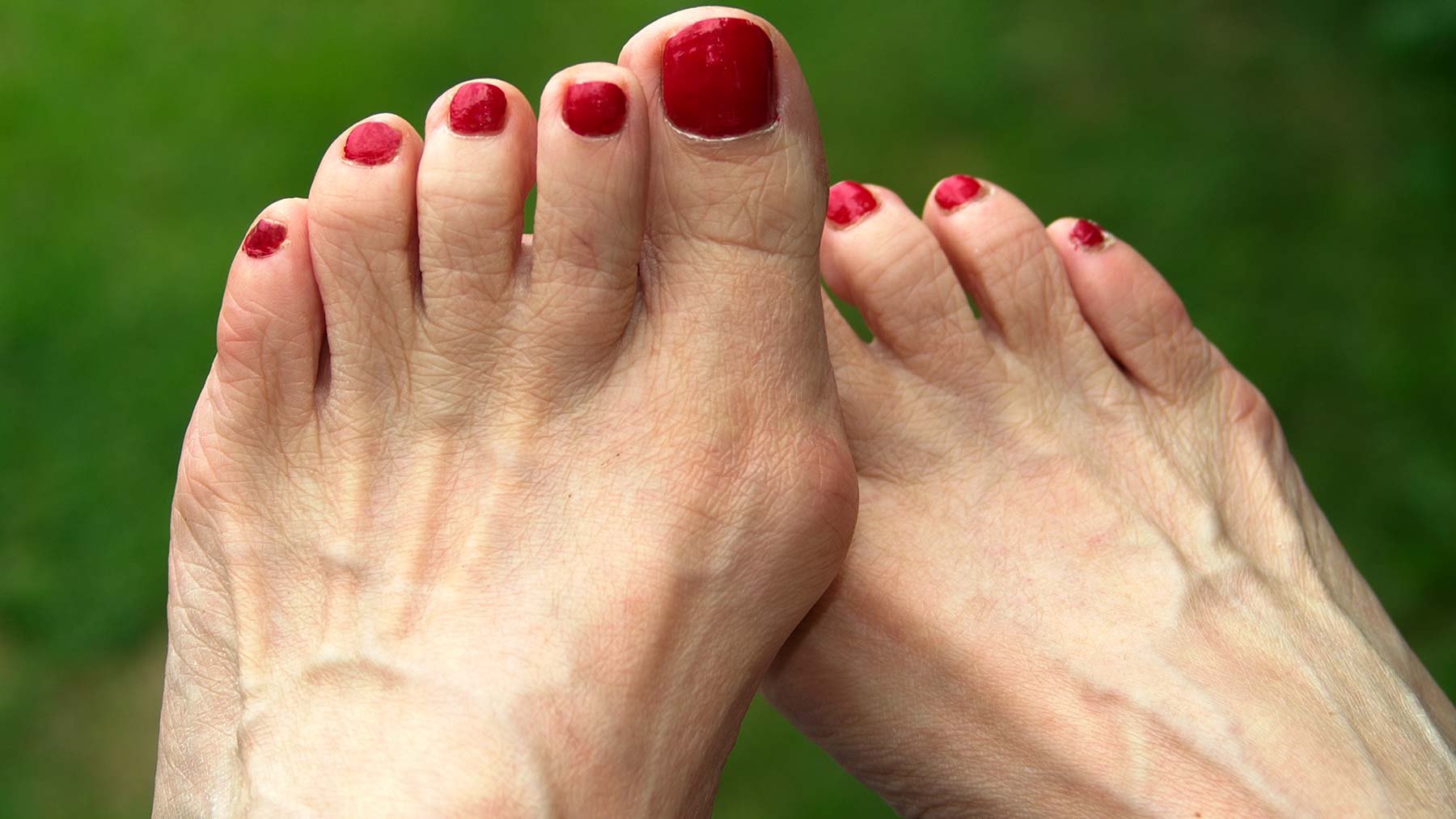 Bunion_large